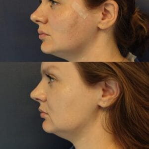Rejuvenare și Lifting Facial Fără Operație cu Fire APTOS cu Acid Hialuronic – Beneficii și Procedură