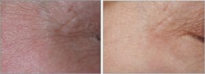 Blefaroplastie Nechirurgicală Laser CO2 – Tratament pentru Rejuvenarea Pleoapelor Fără Chirurgie