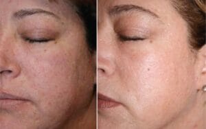 Blefaroplastie Nechirurgicală Laser CO2 – Tratament pentru Rejuvenarea Pleoapelor Fără Chirurgie