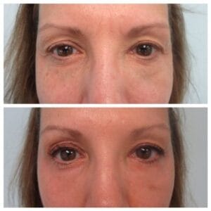 Blefaroplastie Laser CO2 – Tot ce trebuie să știi despre această procedură modernă de întinerire a ochilor