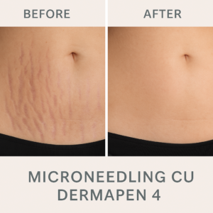 Microneedling dermapen