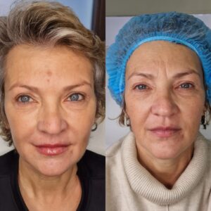 Tratament botox