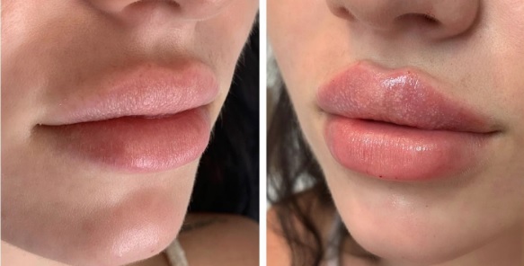 Babydoll Lips - Tehnică de mărire buze