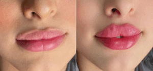 butterfly-lips