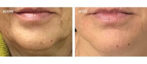 radiesse-biostimulator