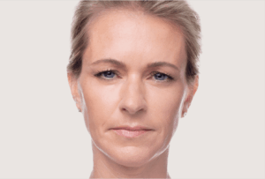 dysport Tratament riduri de frunte dupa