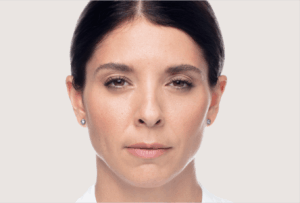 dysport Corecția ridurilor glabelare dupa