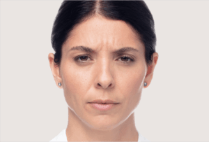 dysport Corecția ridurilor glabelare inainte