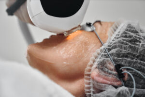 laser-co2-fata- topskin-bucuresti