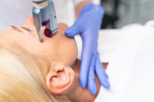 reducere laser co2 ochi topskin bucuresti