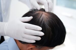 Hair-Loss-Treatment-for-Men and woman