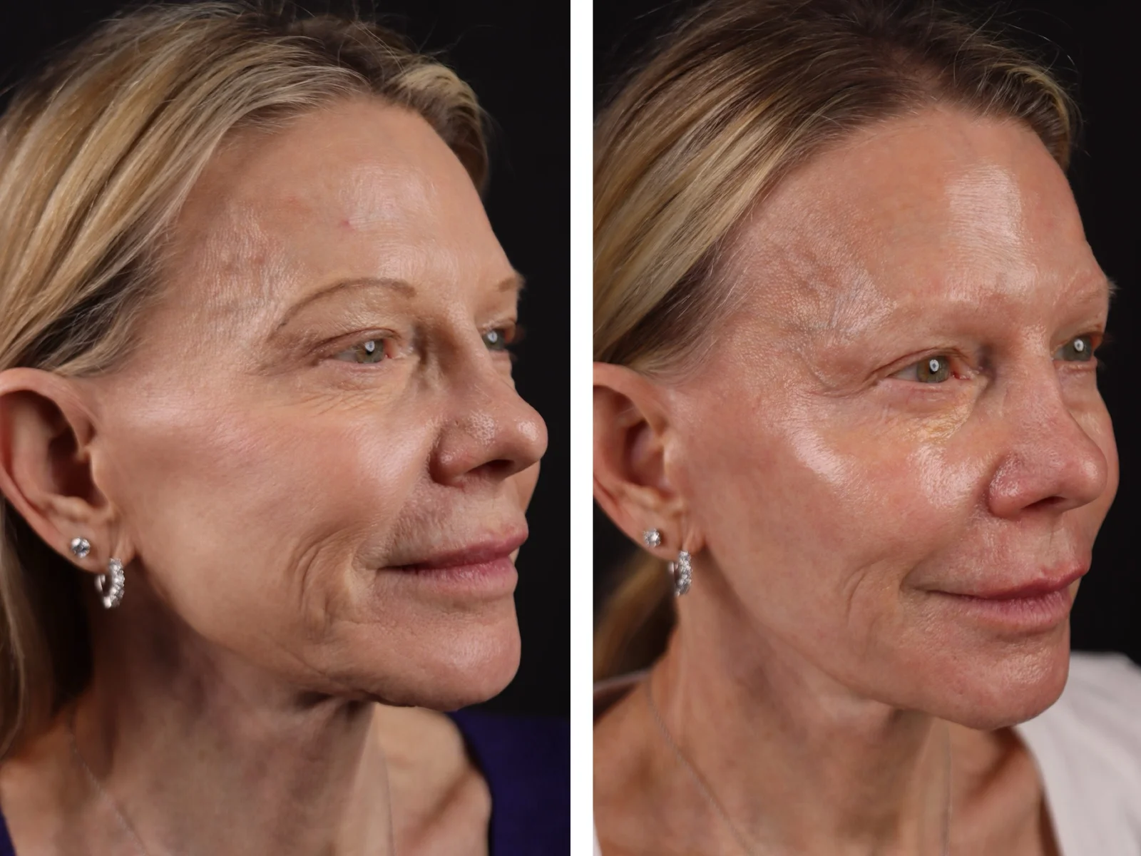 Laser CO2 fracționat - tratament piele