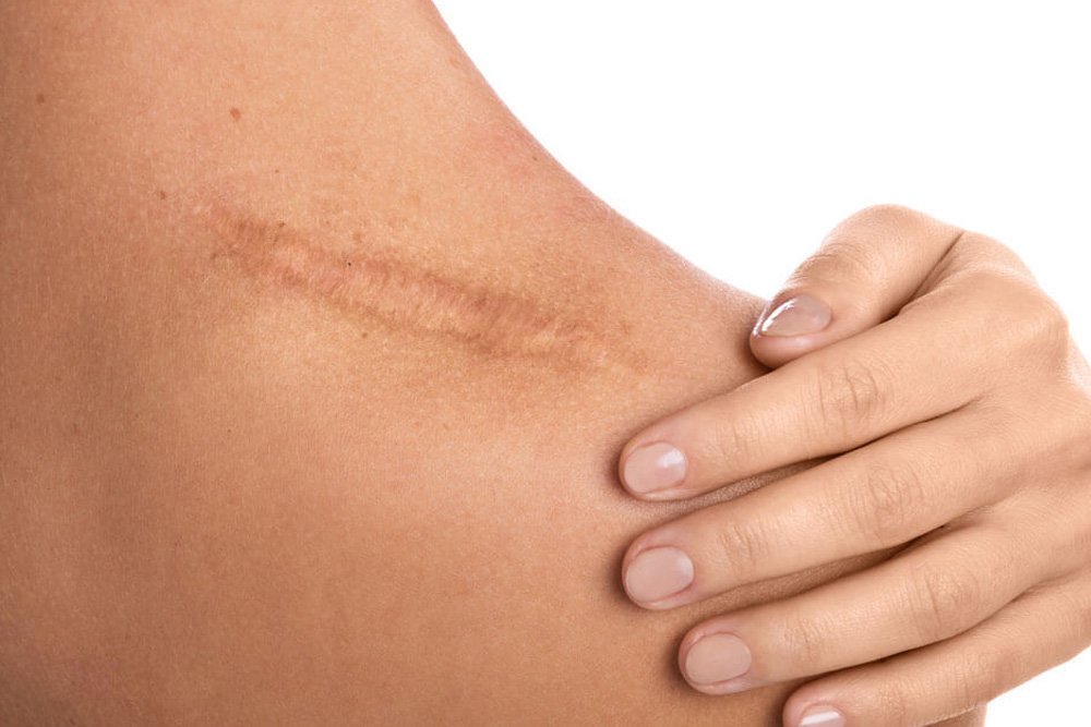Tratament cicatrici corporale