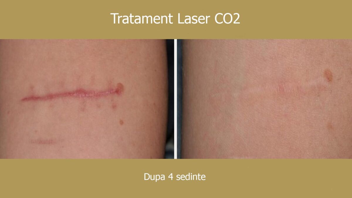 Cicatrici postoperatorii corporale – evaluare si tratament dermatologic la Top Skin