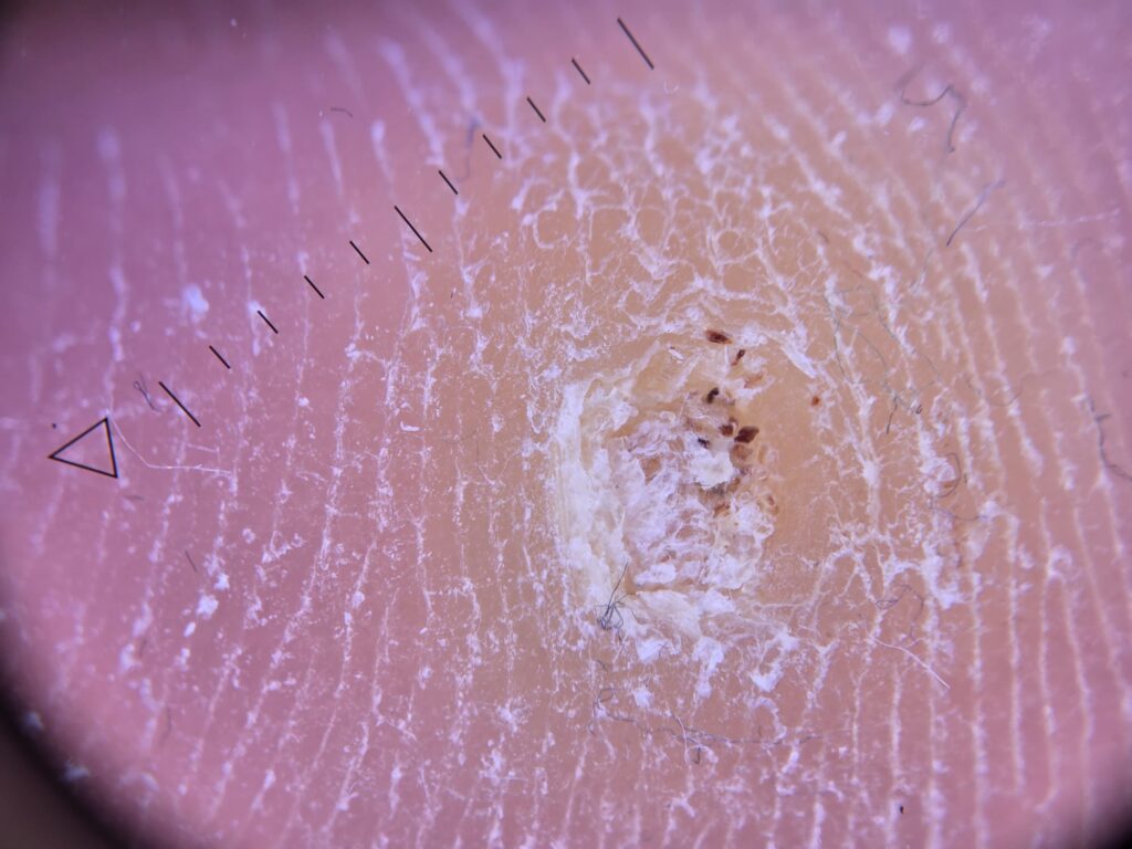 neg pe talpa
veruca pe talpa
dermatoscopie