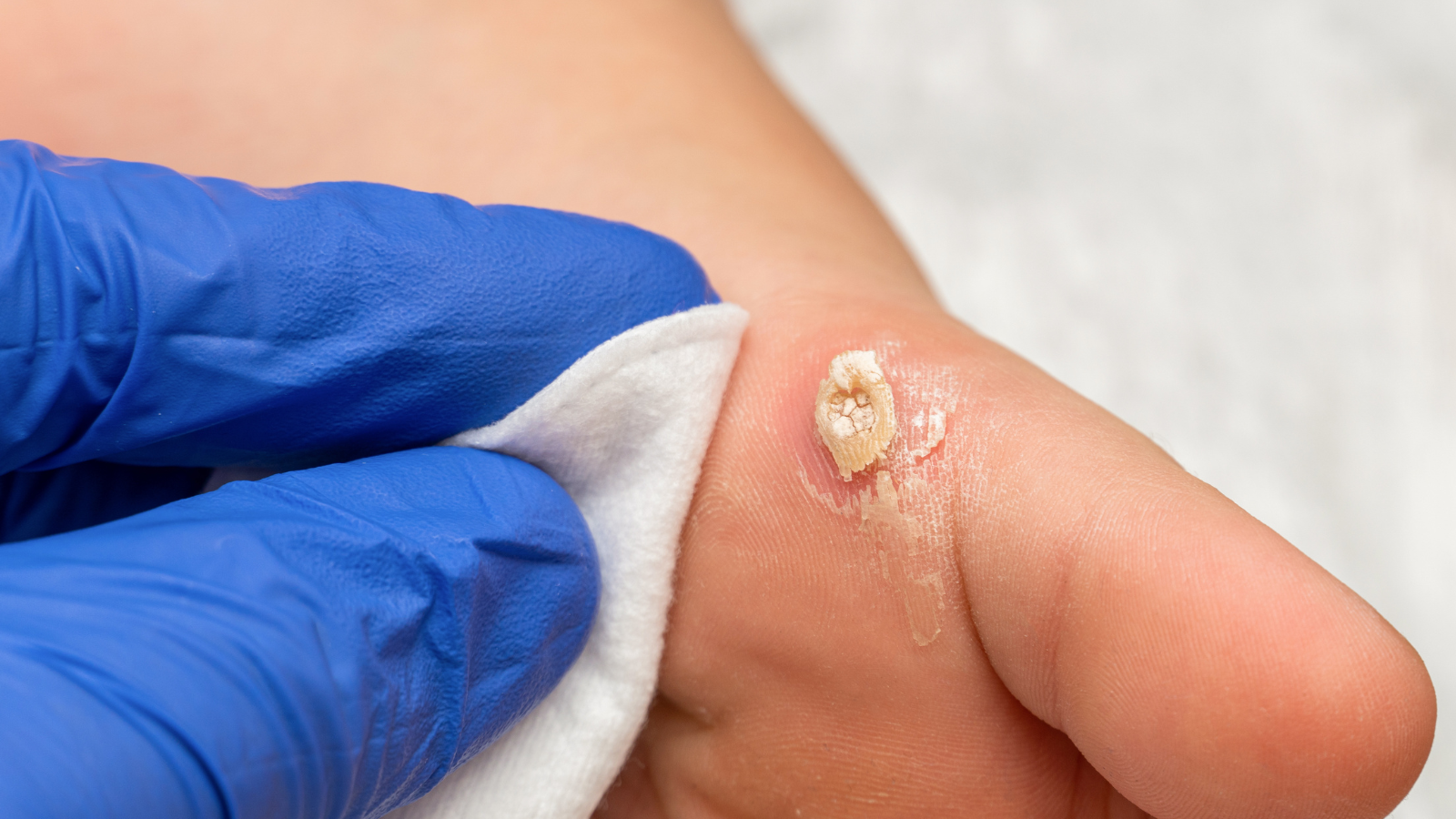 Leziune cu aspect de verucă plantară examinată în cabinet, Top Skin București