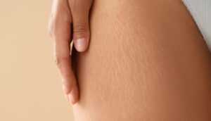 Textura pielii și vergeturi