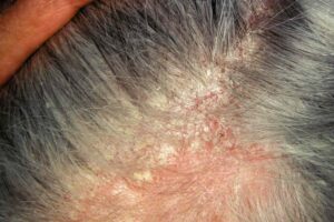 Dermatita seboreica la nivelul scalpului cu descuamare si eritem