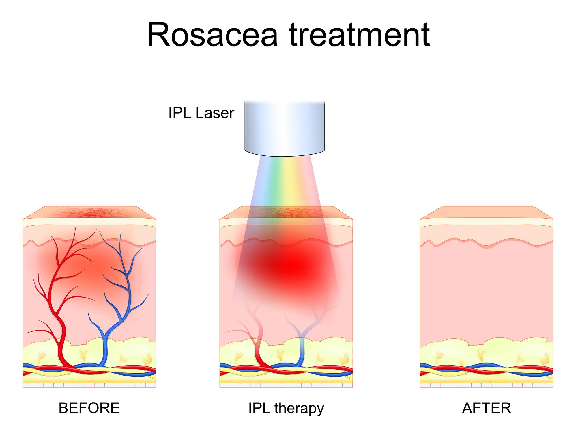 Rozacee – roseata faciala si sensibilitate cutanata
