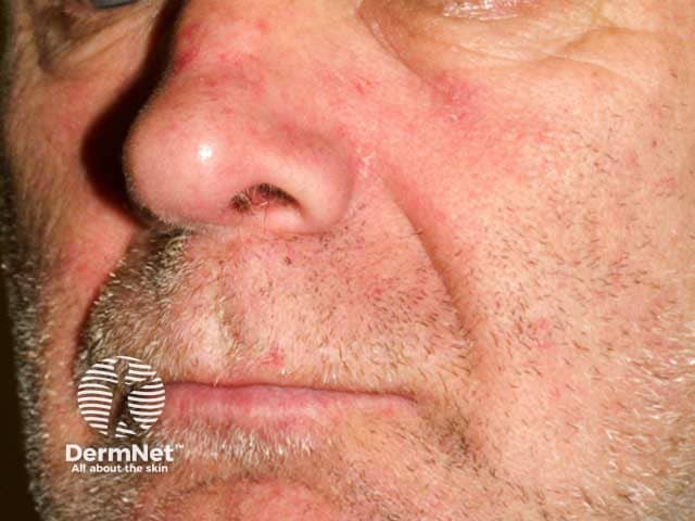 Eritem facial in dermatita seboreica - exemplu clinic