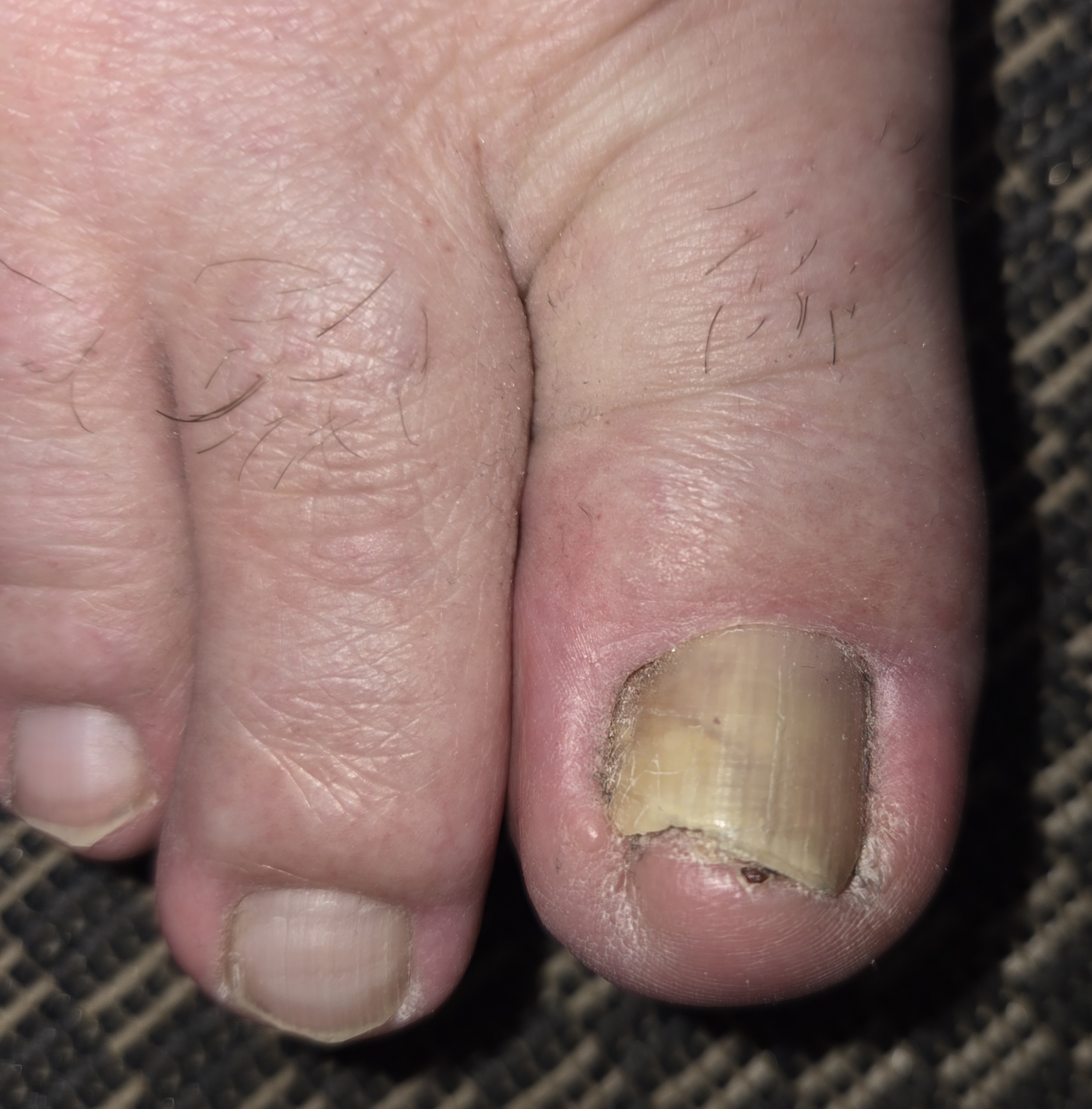 Ciuperca unghiei la picior - onicomicoza evaluata dermatologic