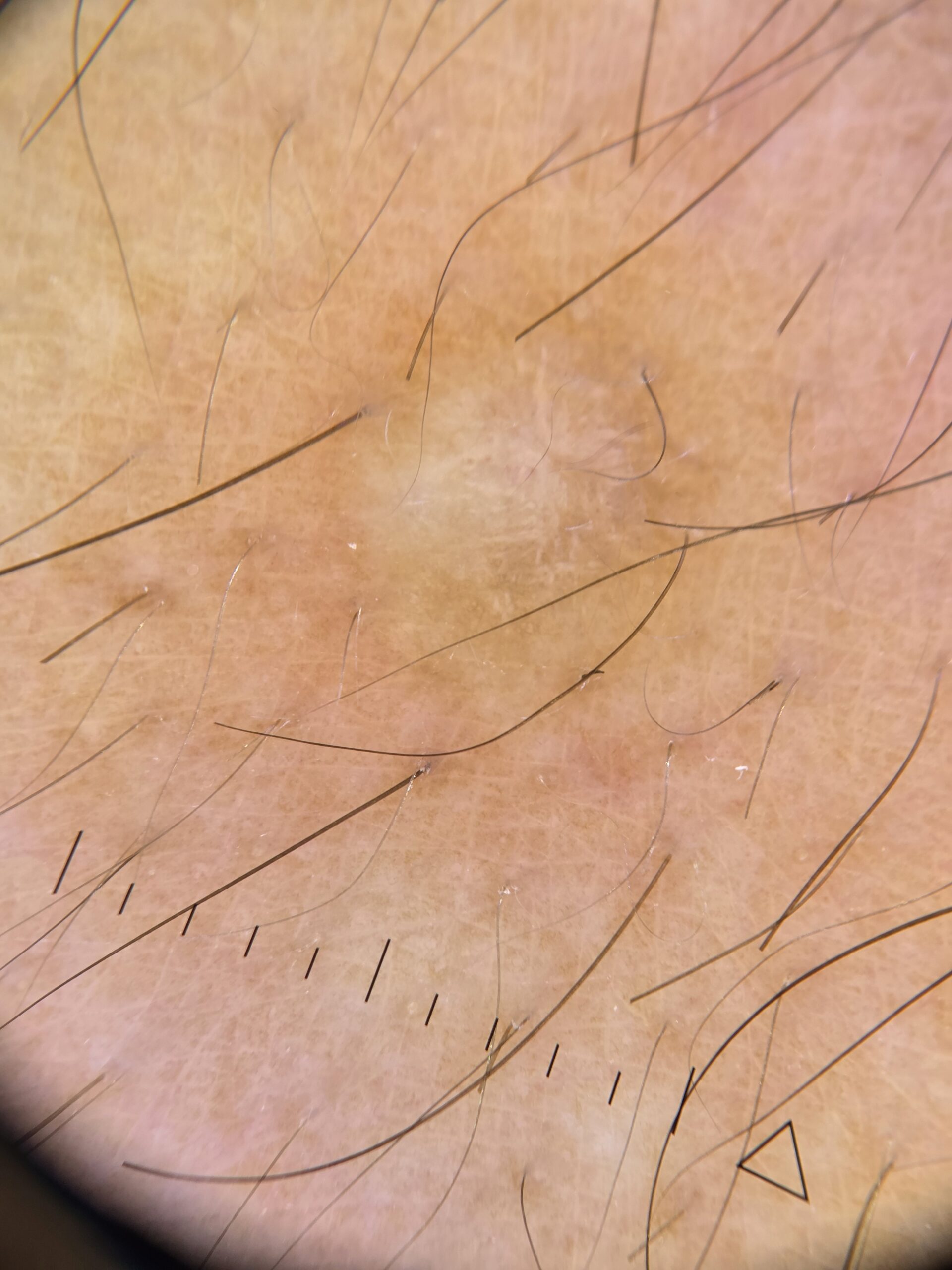 Dermatofibrom - evaluare in consult dermatologic Bucuresti