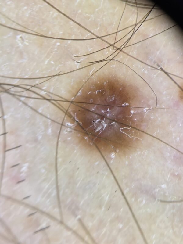 Dermatofibrom - evaluare dermatoscopica