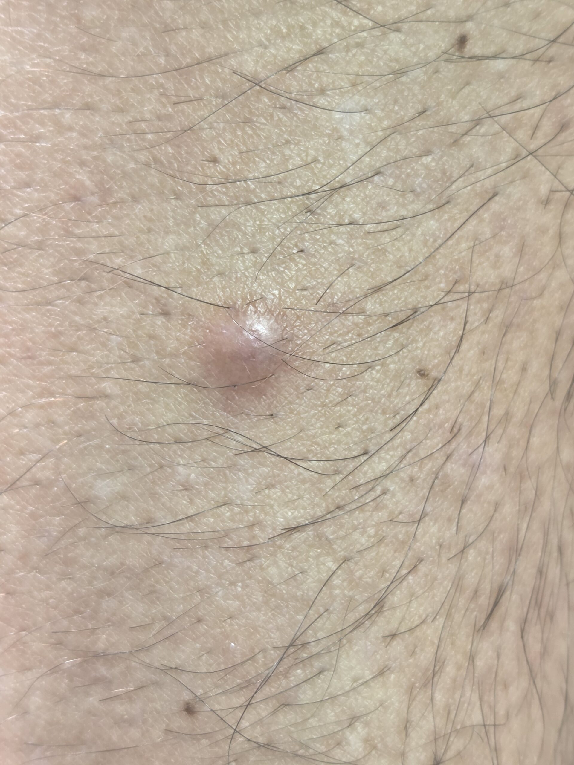 Dermatofibrom - leziune cutanata benigna pe piele