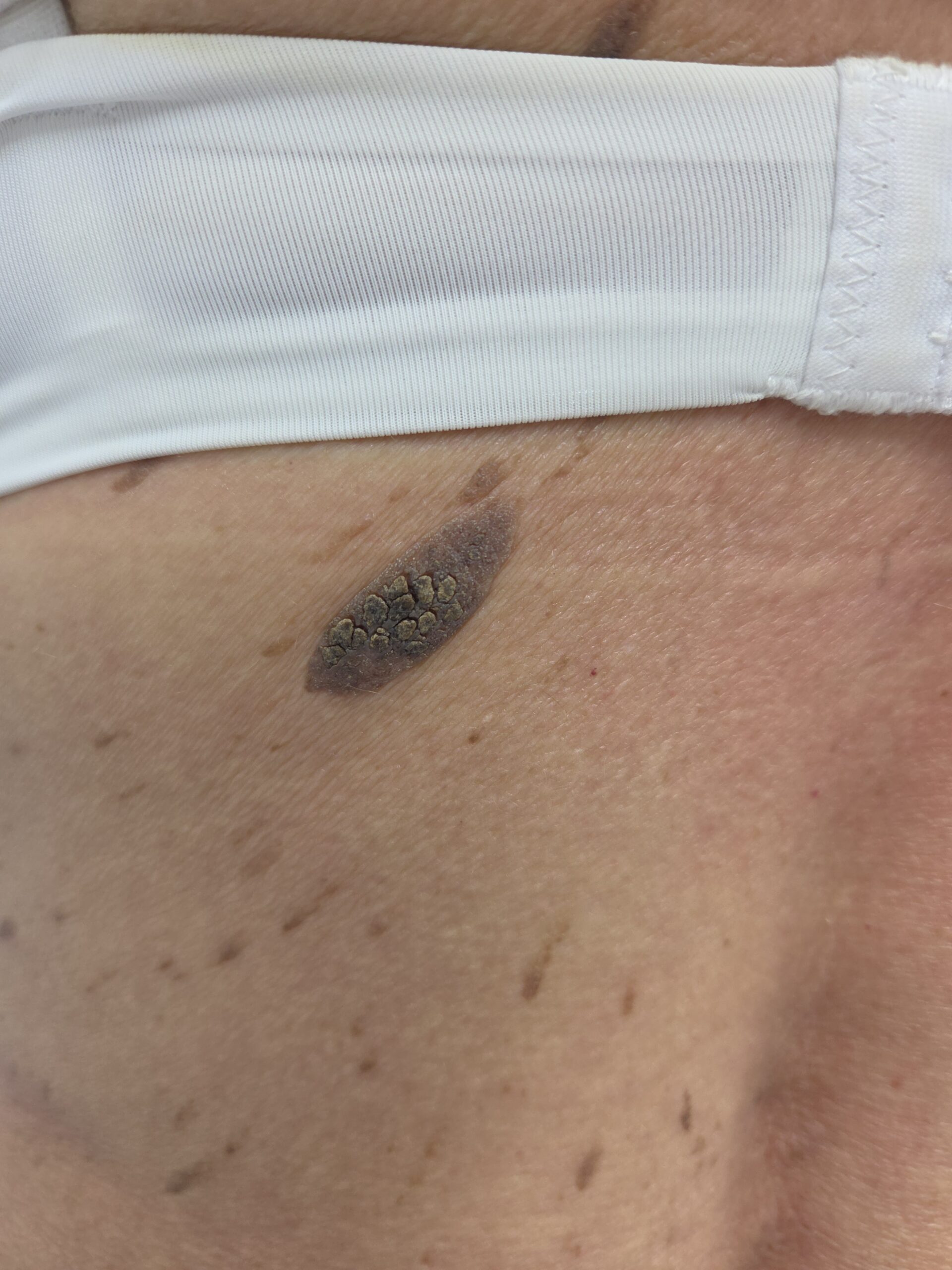 Keratoza seboreica pe corp - aspect clinic tipic
