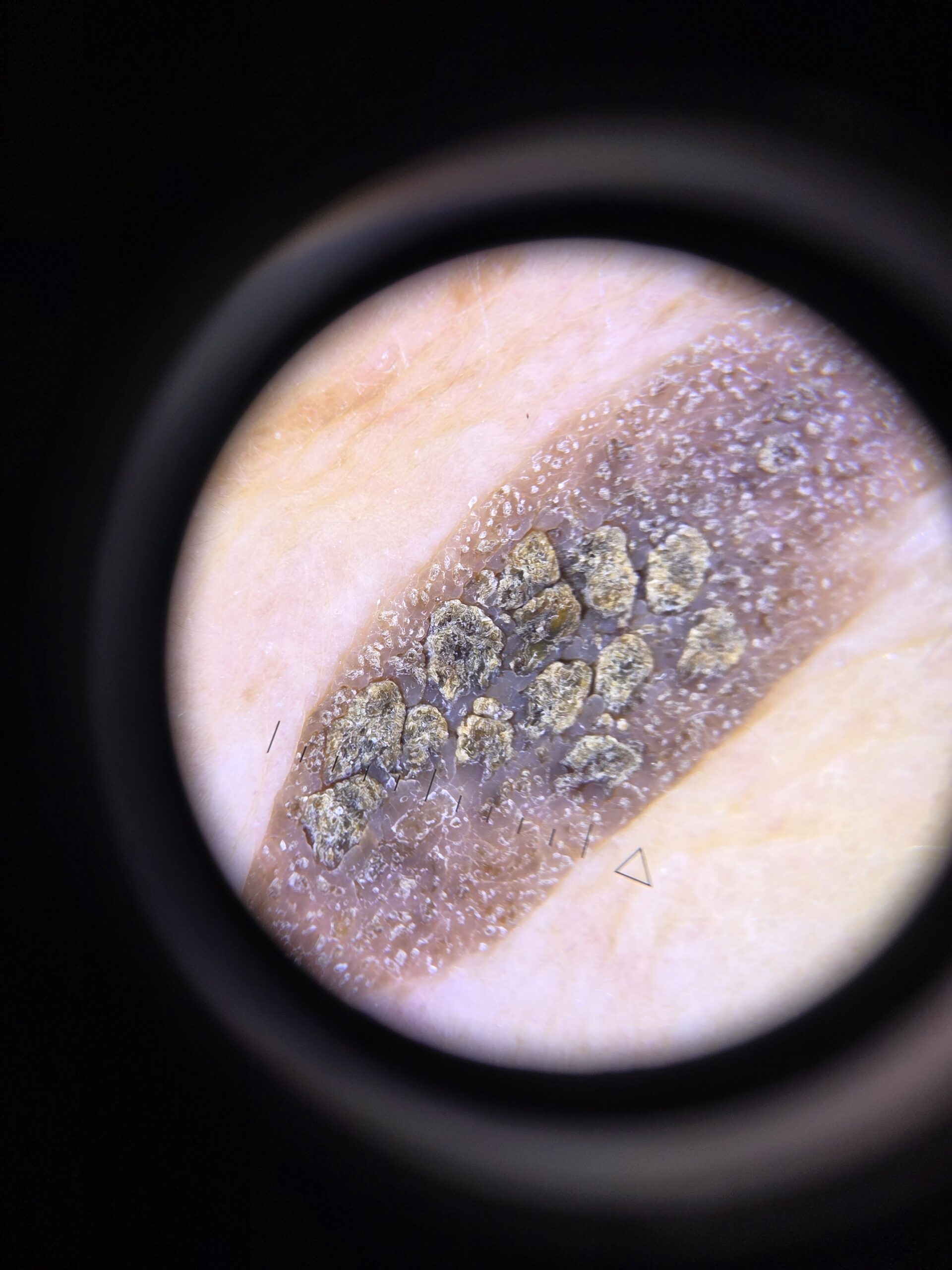 Keratoza seboreica - imagine dermatoscopica corp