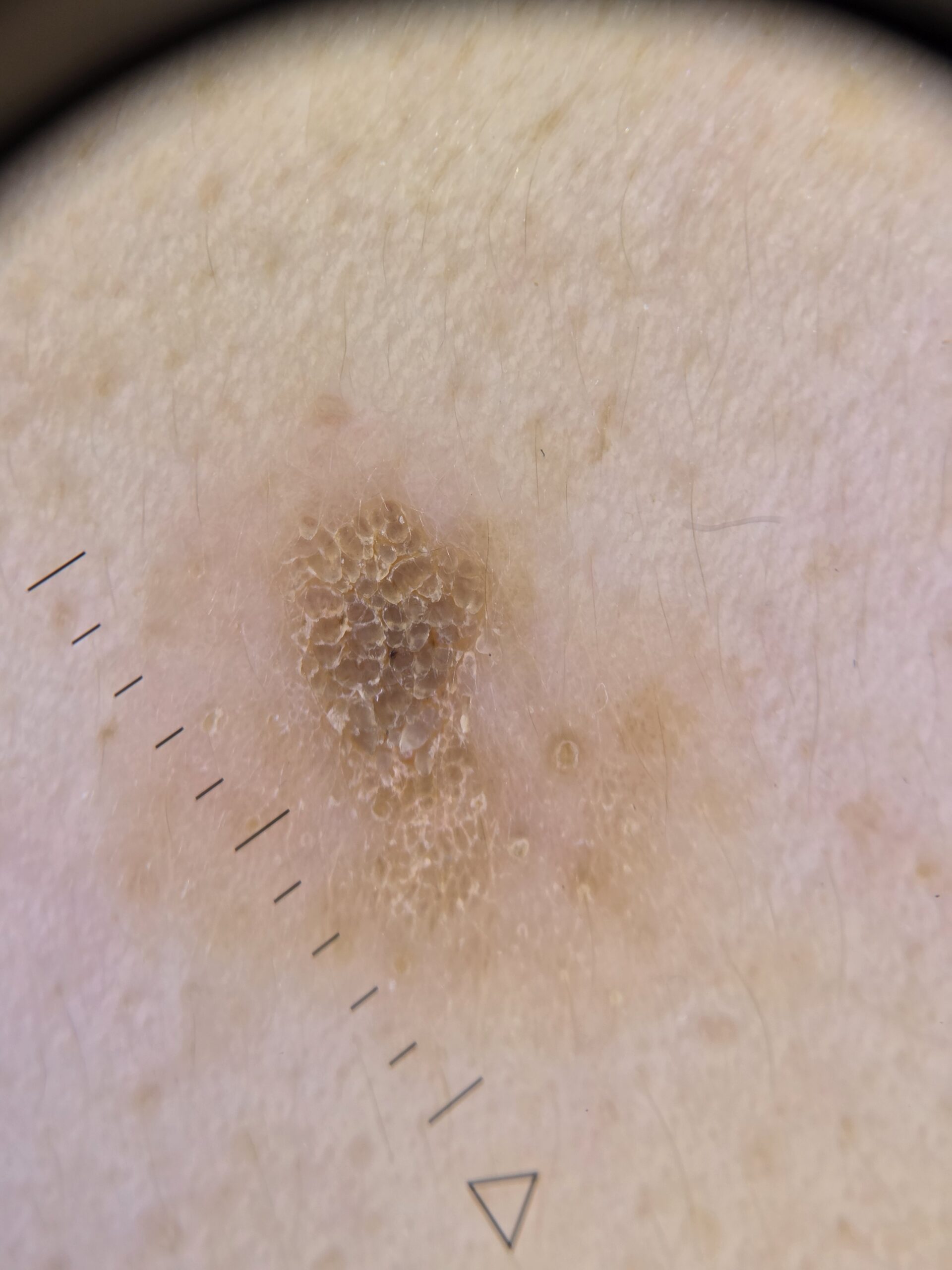 Keratoza seboreica - imagine dermatoscopica fata