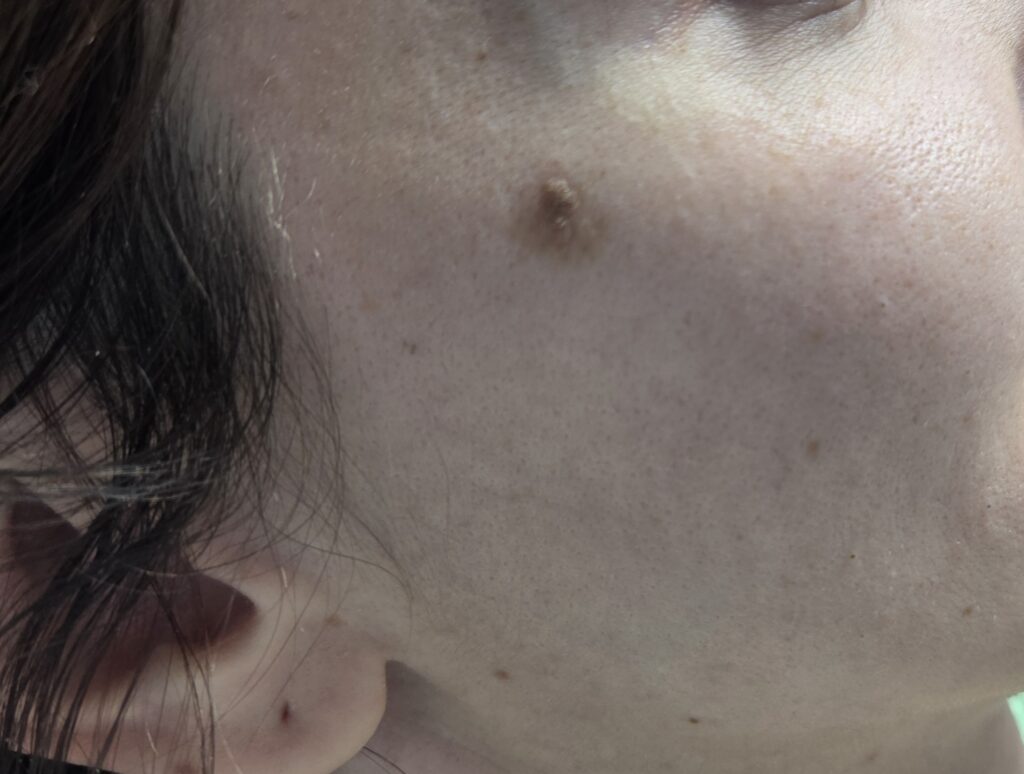 Keratoza seboreica pe fata – evaluare dermatologica la Top Skin Bucuresti
