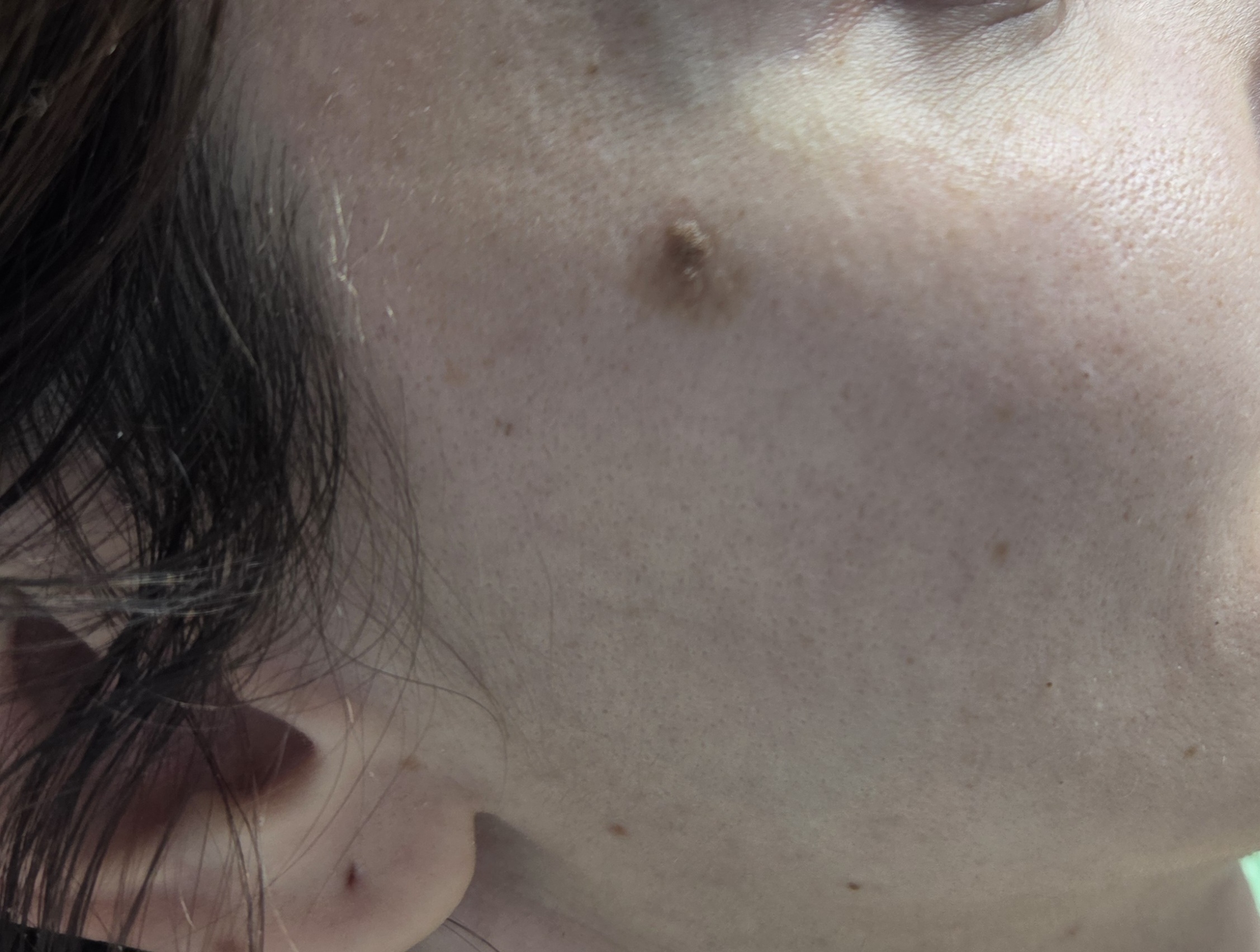 Keratoza seboreica pe fata - evaluare dermatologica Top Skin Bucuresti