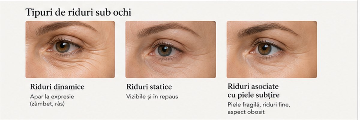 Tipuri de riduri sub ochi dinamice statice si asociate cu piele subtire
