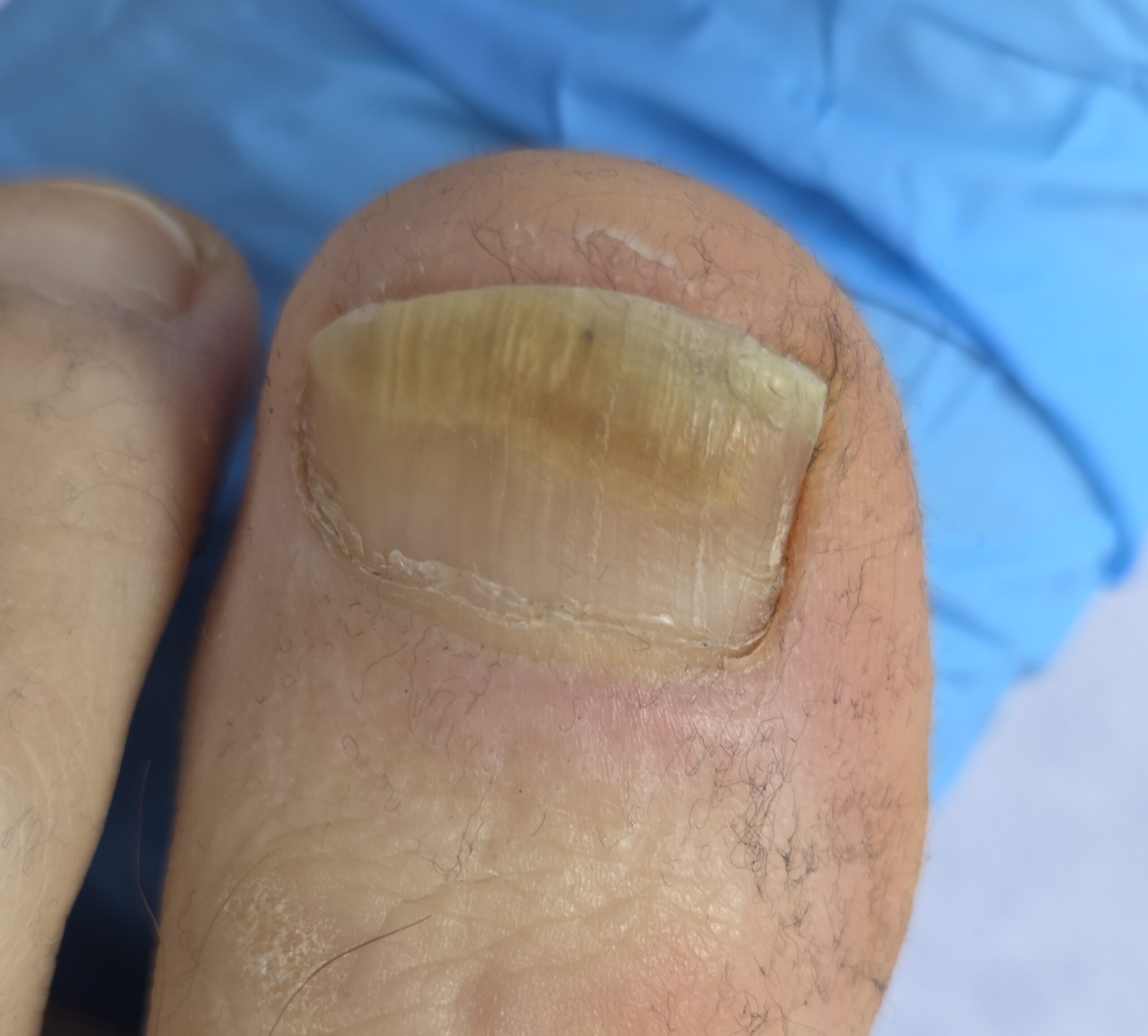 Tratament ciuperca unghiei la dermatolog in Bucuresti