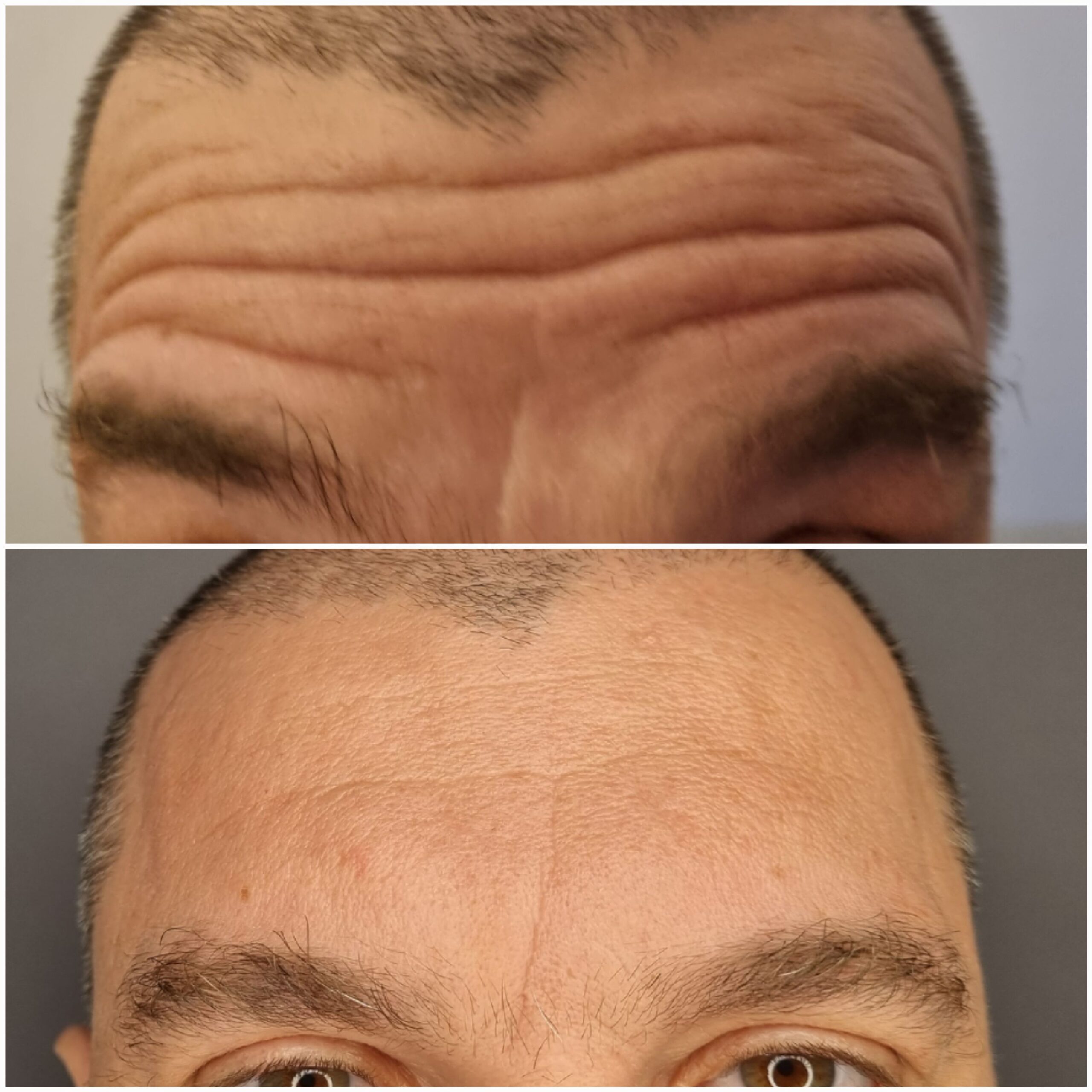 Rezultat Botox pentru ridurile frunții la bărbat, caz real TopSkin București