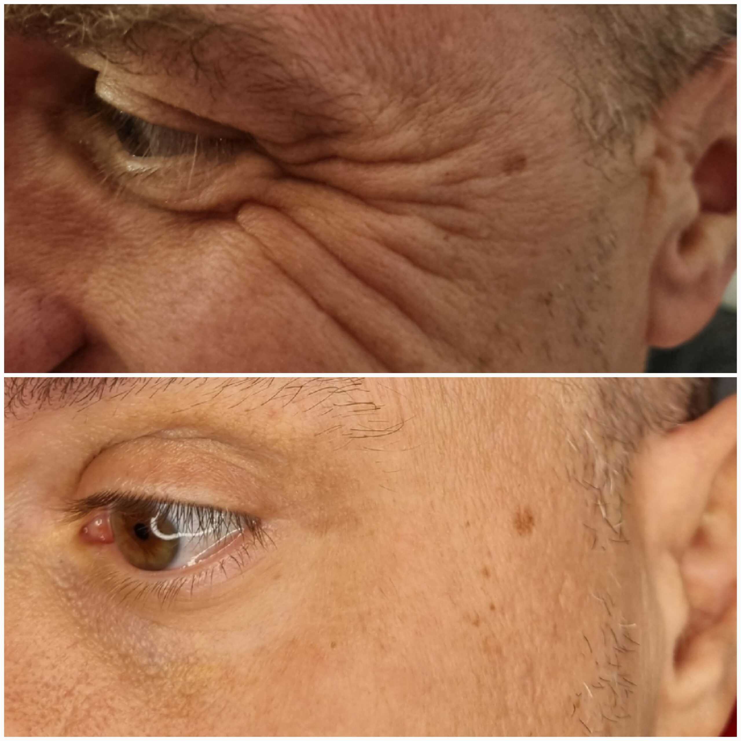 Rezultat Botox pentru ridurile din jurul ochilor la bărbat, caz real TopSkin București