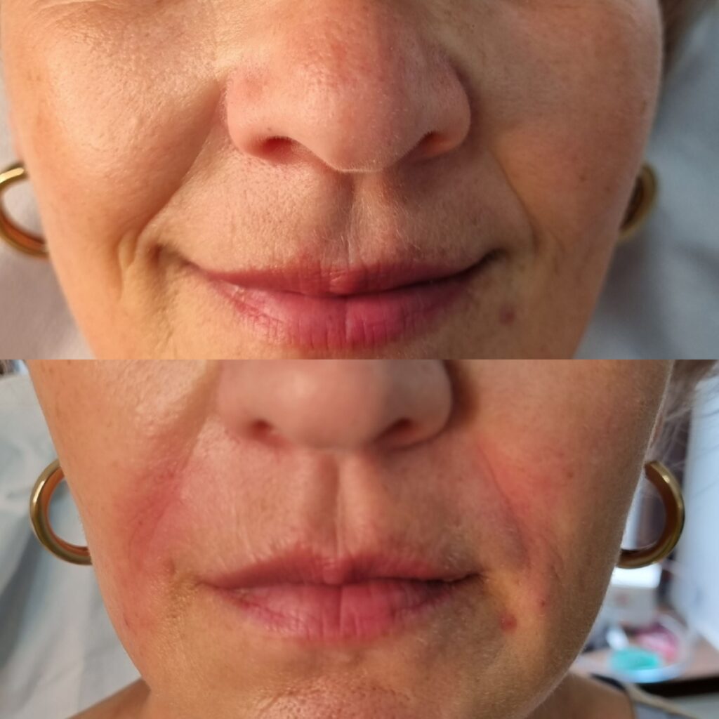 Înainte și după injectarea șanțurilor nazolabiale cu acid hialuronic la TopSkin București