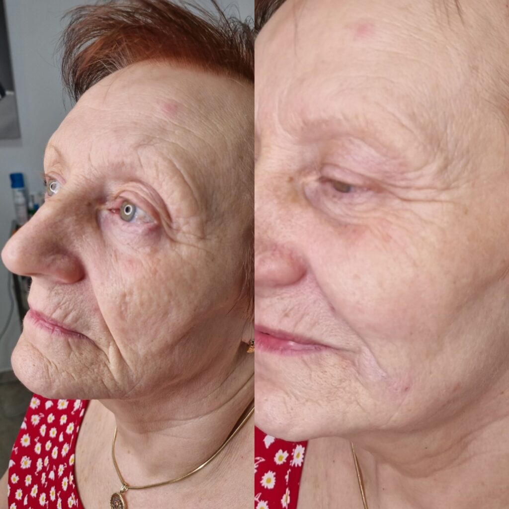 Înainte și după corectarea șanțurilor și susținerea treimii inferioare la TopSkin București