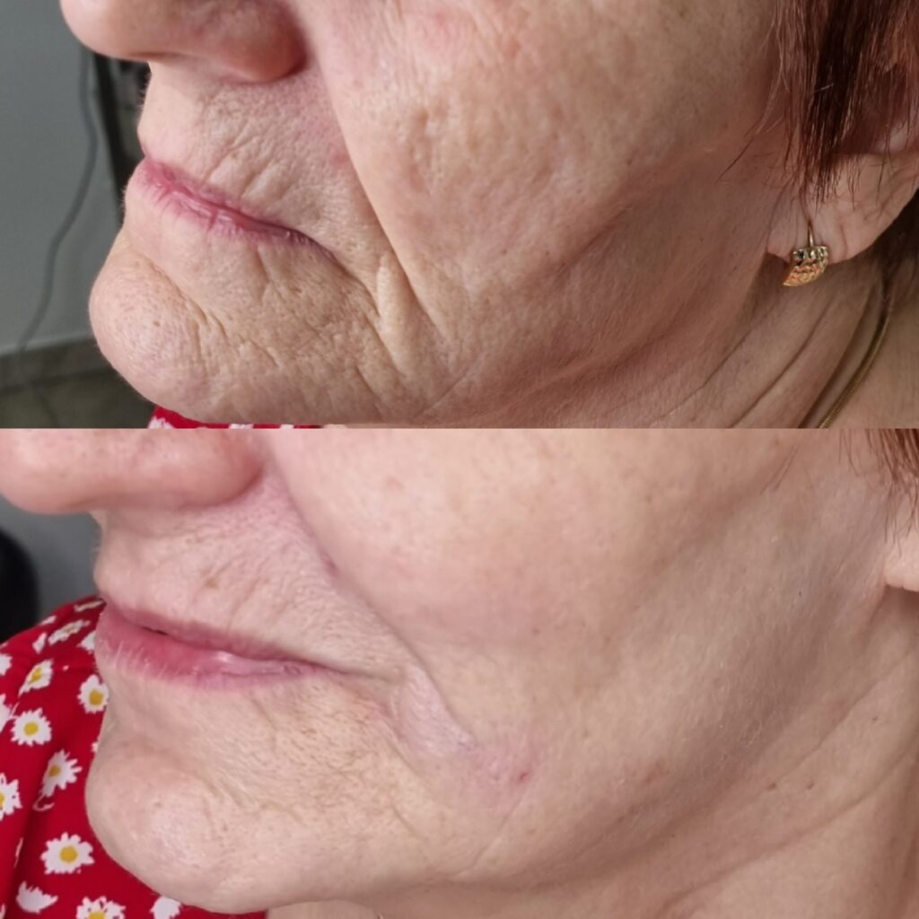 Profil înainte și după corectarea șanțurilor și treimii inferioare la TopSkin București