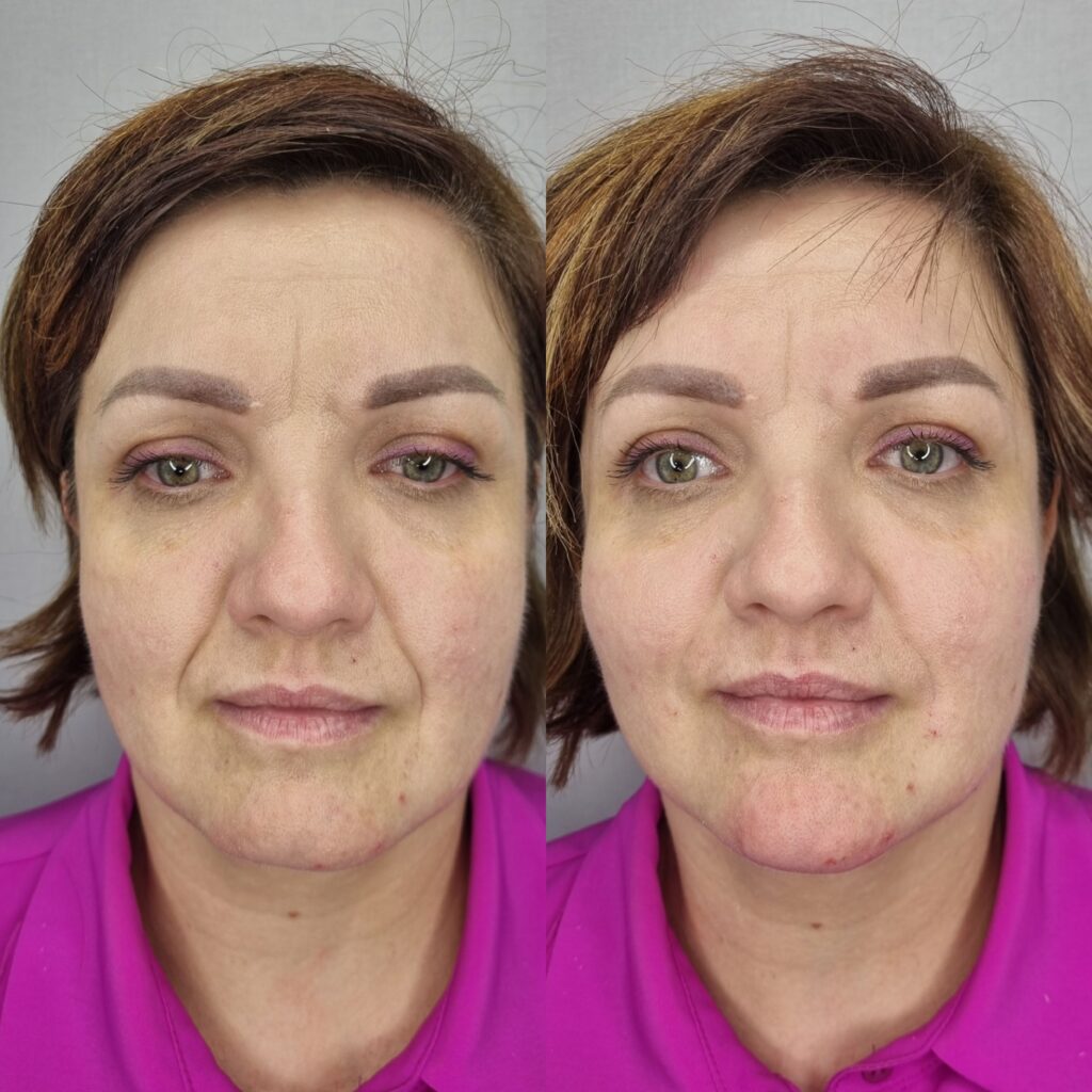 Înainte și după susținerea midface-ului și estomparea șanțurilor la TopSkin București