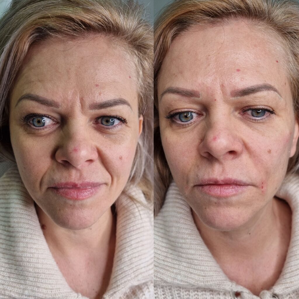 Înainte și după corectarea midface-ului și șanțurilor nazolabiale la TopSkin București