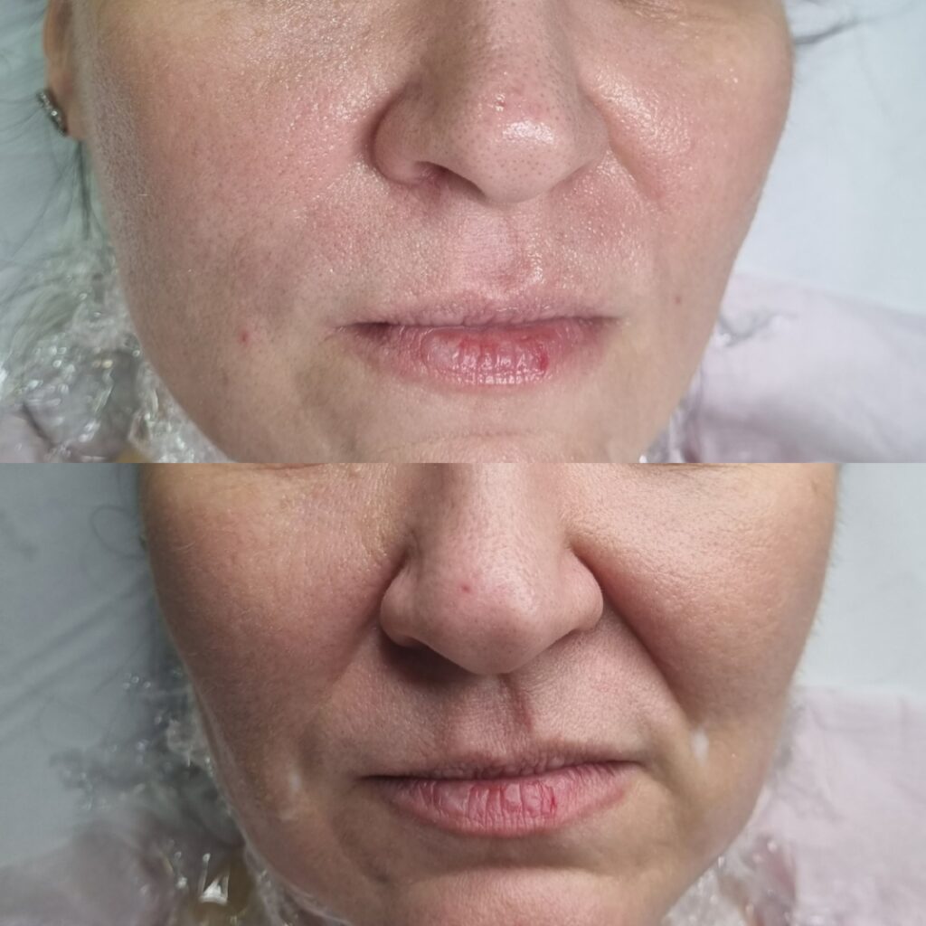 Înainte și după injectarea șanțurilor nazolabiale și liniilor marionetă la TopSkin București