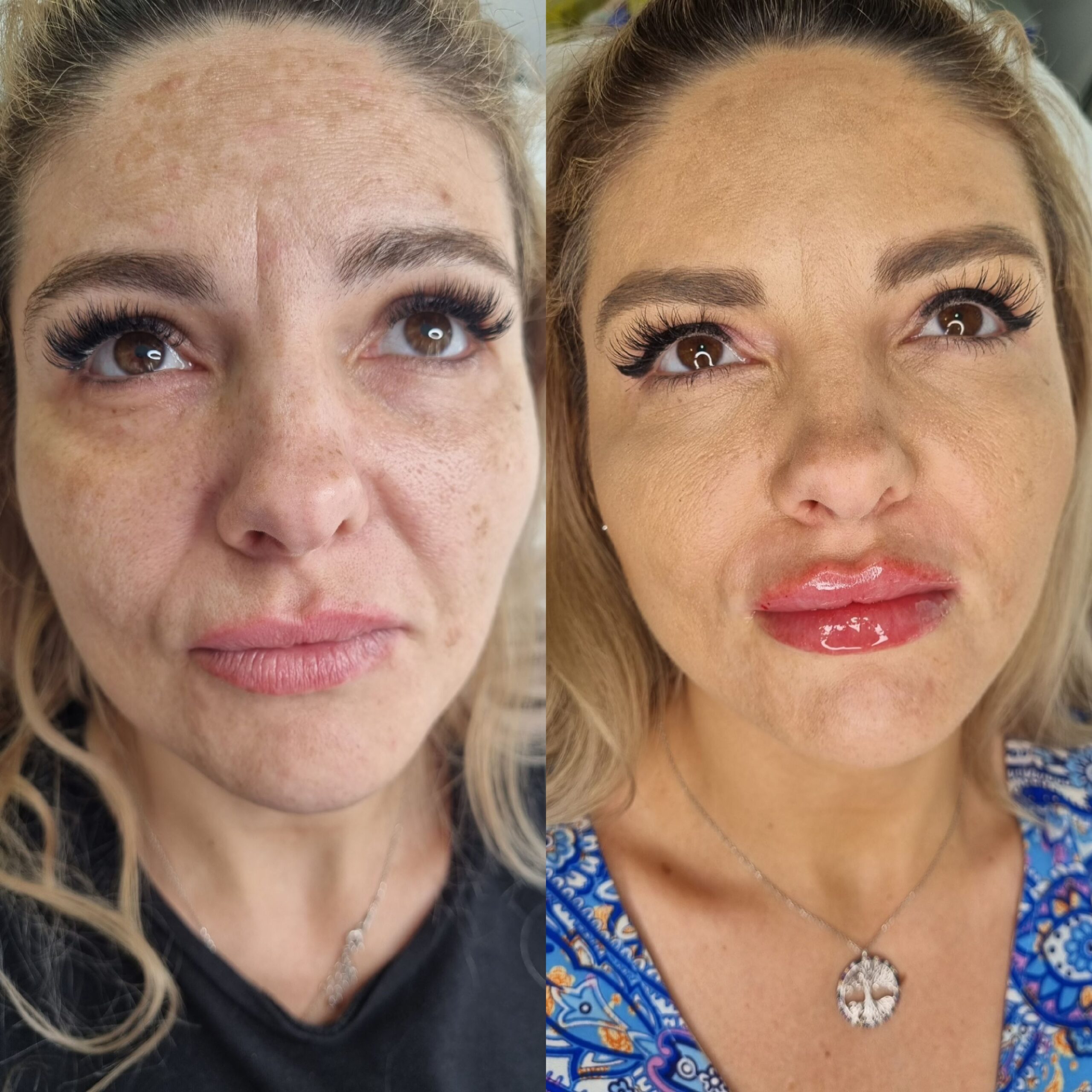 Caz real înainte și după 3 ședințe Laser CO2 și 2 ședințe Sculptra la Top Skin