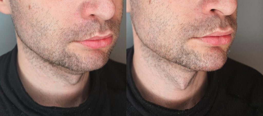 Rezultat estetic masculin la nivelul mentonului, caz real tratat la Top Skin București