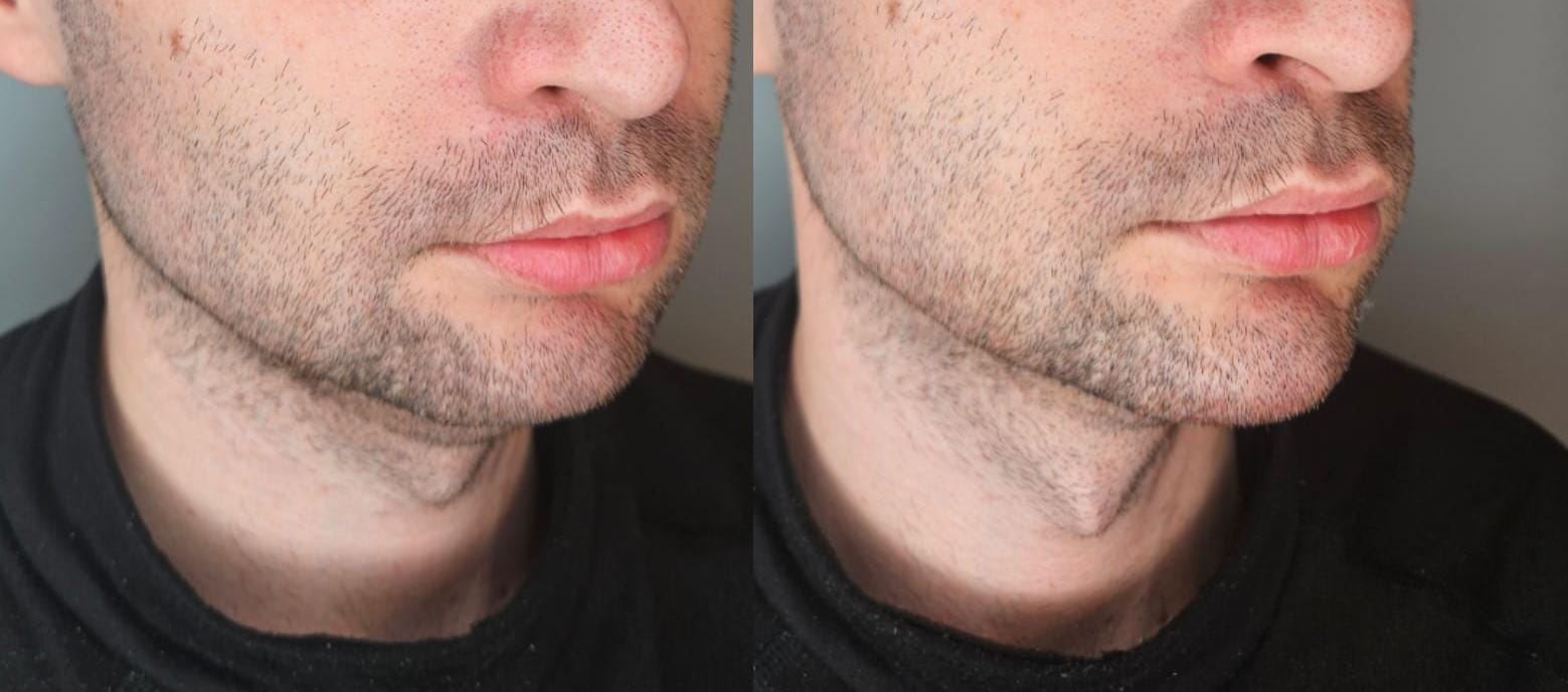 Rezultat estetic masculin la nivelul mentonului, caz real tratat la TopSkin București