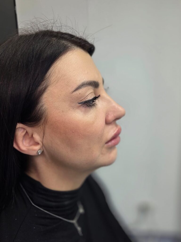 Profil după conturarea bărbiei și mandibulei la Top Skin București