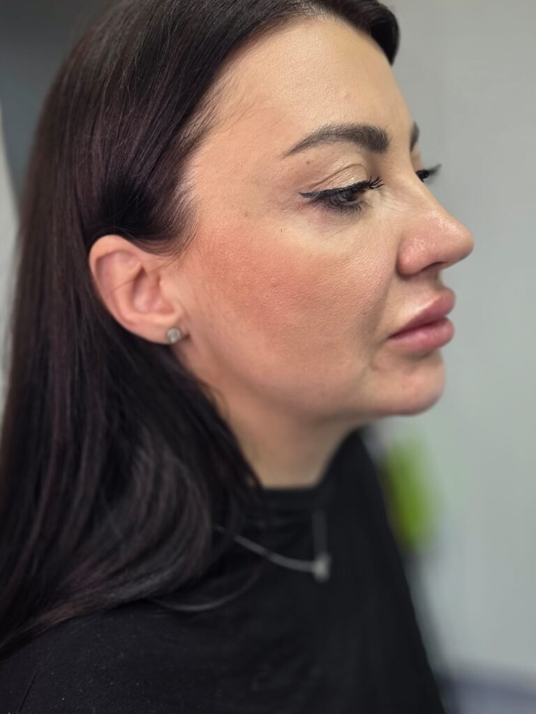 Rezultat de profil pentru menton și jawline la Top Skin București
