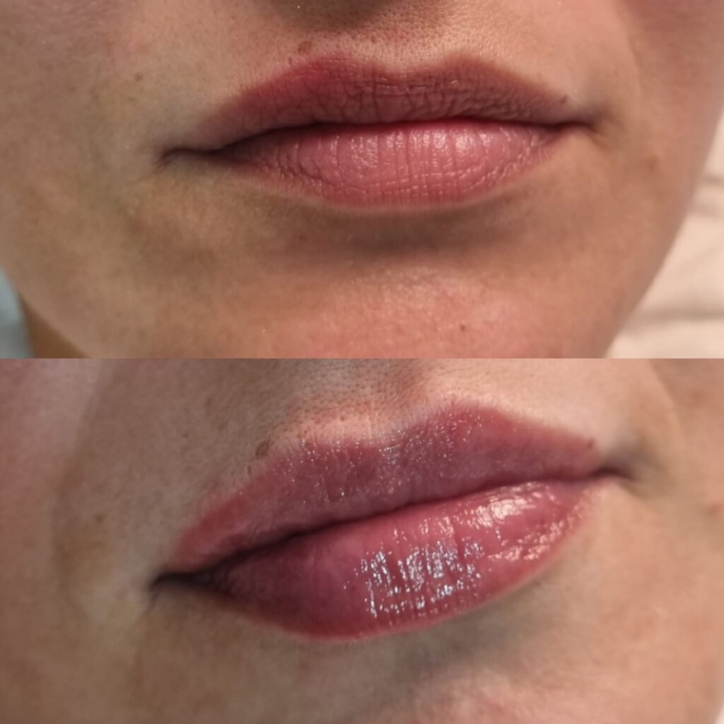 Înainte și imediat după injectarea buzelor cu acid hialuronic – rezultat real Top Skin, volum feminin echilibrat