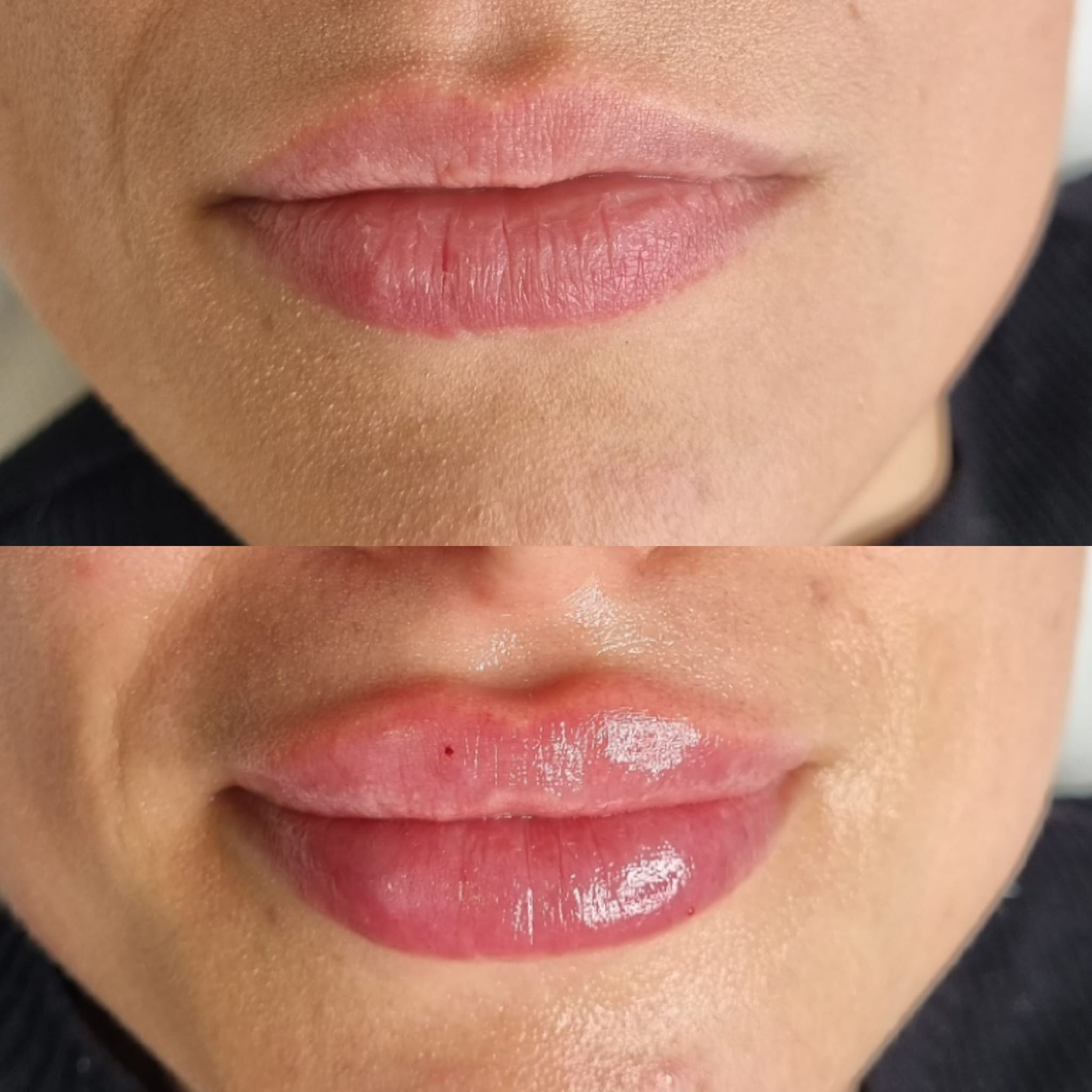Înainte și imediat după mărirea buzelor cu acid hialuronic – rezultat real Top Skin